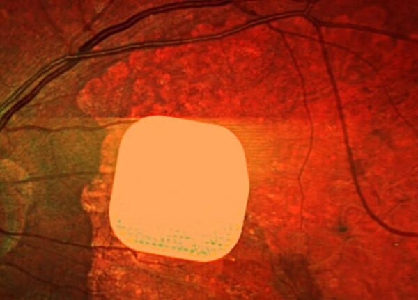 Технології - Британські лікарі частково повернули зір пацієнтам за допомогою мікрочипа