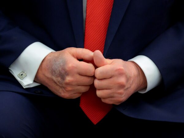 Новини світу - Повторні синці на руці: у США обговорюють здоров'я Трампа